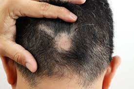 hair loss treatment restoration l a