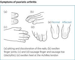 The joints in the hands and fingers are very delicate. Psoriatic Arthritis Psoriatic Arthritis Causes Symptoms Treatments