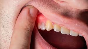 can a cold cause swollen gums