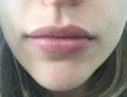 uneven asymmetrical lips after dermal