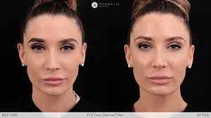However, these changes are completely normal and occur when we lose some of the subcutaneous fat that supports our skin. Magnolia Mediclinic Dermal Filler
