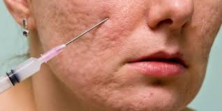 fillers for acne scars cost procedure