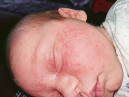 Breastfed babies are reacting to the dairy his mother has eaten in its efforts to fend off the invaders, the body releases histamine and other chemicals, which cause allergic symptoms in the body. Cmpa Rash Symptoms Advice From A Mum Who S Lived It