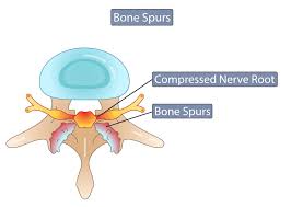 bone spurs symptoms causes what is