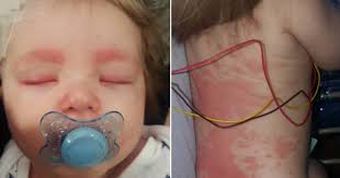 Meningitis might happen during or after a viral infection like a cold. Meningitis Rash Completely Covers Baby S Body In 12 Hours Mom Warns Cbs News