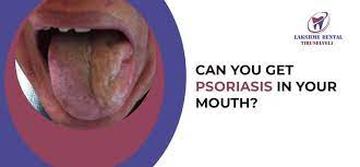 psoriasis psoriasis in mouth