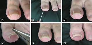 pincer nail deformity