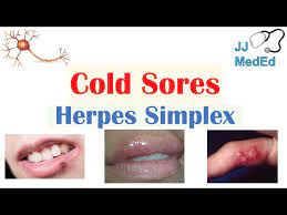 cold sores herpes causes
