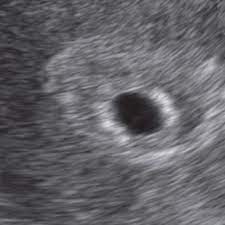 Wie sicher das ergebnis wirklich ist und demnach ist auf dem ultraschall auch noch nichts von dem kleinem embryo zu sehen. á… 5 Ssw Schwangerschaftswoche Alle Infos Grosse Entwicklung