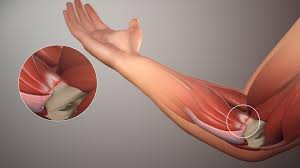 al epicondylitis inner elbow pain