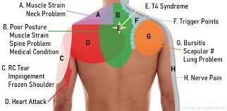shoulder pain diagram diagnosis chart