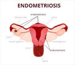 It can occur inside, on, or around the intestines. What Is Endometriosis