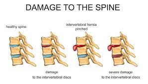 Apa saja penyebab nyeri punggung bagian bawah? Sakit Tulang Belakang Mula Menyerang Ini Sebabnya