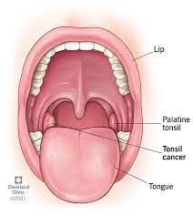 Tonsillar Tumors gambar png