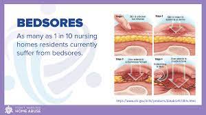bedsores fight nursing home abuse