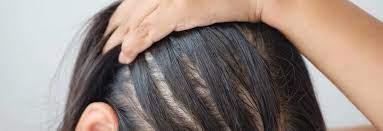This can help your scalp feel less dry. How To Handle Treat Female Hair Loss Dermatology Mohs