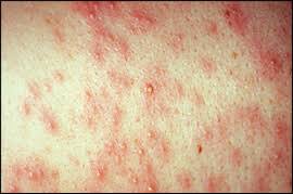 baby heat rash signs symptoms