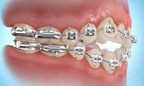 Rubber bands with braces may seem difficult, but with a few tips and tricks from this article, you'll know how to put rubber bands on braces in no time. How To Put Rubber Bands On Braces Premier Orthodontics