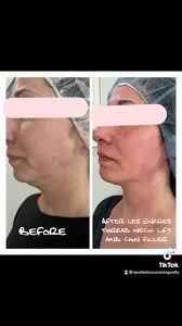 Lift your neck and define your jaw line with a Les Encres thread neck lift!  Book you concierge in home appointment at...