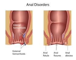 what is an rectal abscess how is