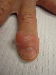 mucous cyst in finger