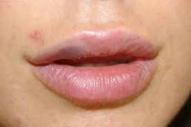 blistex lip balm for bruises