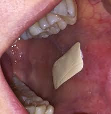plaster which sticks inside the mouth