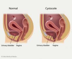 bladder cystocele repair