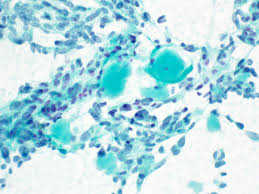 It is normally carried out on thyroid nodules when they are suspected to be your doctor and cytologist will give you excellent guidance on any preparations needed. Chris Vandenbussche On Twitter Fine Needle Aspiration Of Medullary Thyroid Carcinoma Discohesive Spindle Cells And Amyloid Cytology Cytopathology Fna Https T Co A5fs484vpl