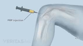 Image result for Did you know Platelet Rich Plasma (PRP) injection help knee arthritis?