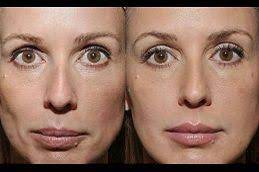 sculptra fillers in dubai abu dhabi