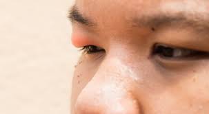 reasons why your eyelid is swollen