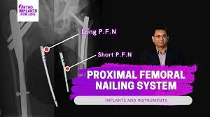 proximal fem nailing system pfn