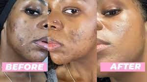 dark spots from acne on black skin