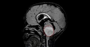 pediatric brain tumor