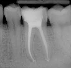 RÃ©sultat de recherche d'images pour "endodontie dentaire"