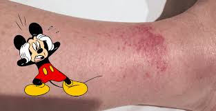 the disney rash what it is and how to