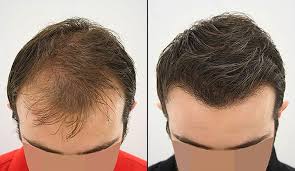 زراعة الشعر | نسبة نجاح زراعة الشعر | عوامل فعالة في نسبة نجاح زرع الشعر  بین النساء و الرجال
