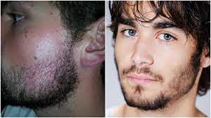 There are some ways to grow facial hair faster, and it is about the usage of some substances to make the hair face rapidly growing. How To Grow Facial Hair On Your Cheeks Beardstyle
