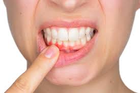 درمان تحلیل لثه با دهانشویه فلوراید
