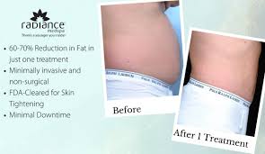 laser lipo sculpting in clearwater