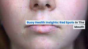 red spots in the mouth how to treat