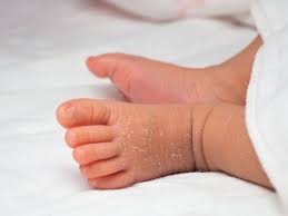 newborn skin ling causes and treatment