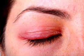 ocular rosacea causes symptoms