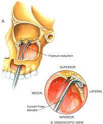 endoscopic transantral repair of