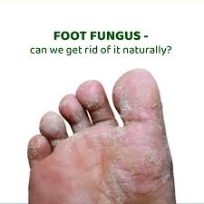 athlete s foot fungal infection