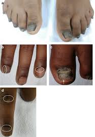 nail psoriasis and onychomycosis