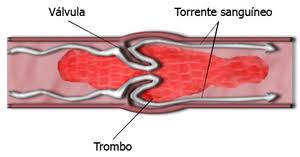 What are the signs and symptoms of thrombosis? Trombosis Wikipedia La Enciclopedia Libre