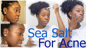 clear acne dark spots fast w sea salt