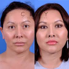 upper lip lift surgery